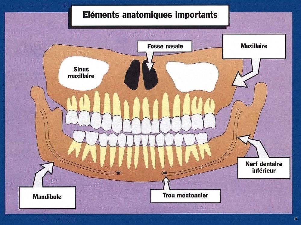 Différences entre dents et implants